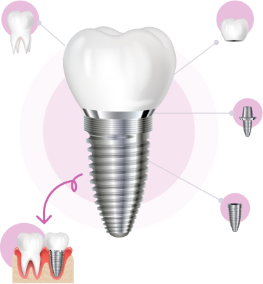 Dịch vụ Implant là gì?